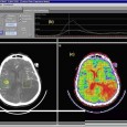 Introduction Ischaemic stroke is a very common disease that affects blood vessels in the brain causing cerebral tissue damage. Despite several studies on this subject, the early detection of acute […]