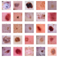 Learn to identify skin cancer and other conditions from dermoscopic images We show how to use fast.ai to solve the 2018 Skin Lesion Analysis Towards Melanoma Detection challenge and automatically […]